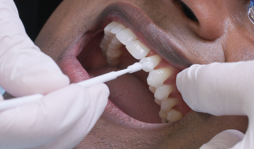 Topical Fluoride Treatments – What do you prioritise?